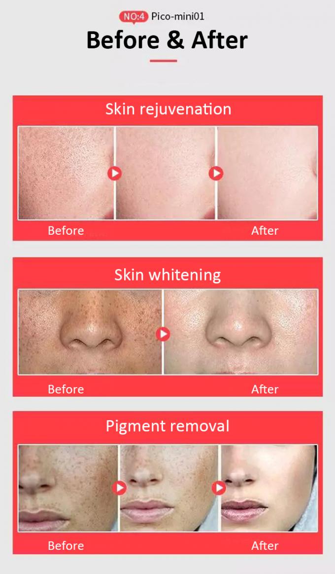 Honkon Portable Picosecond Laser Tattoo Removal Pigmentations Treatment 1