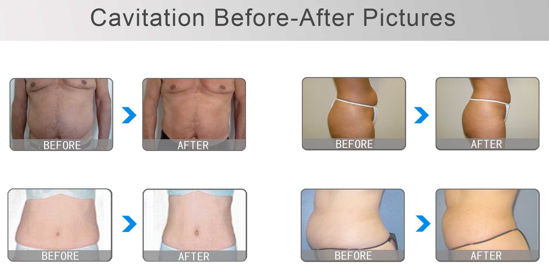 2018 Nubway ultrasonic slimming machine/slimming cavitation machine