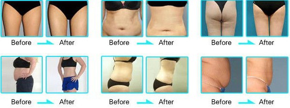 2019 Nubway portable cryolipolysis fat freeze slimming machine/cryolipolysis slimming machine