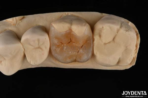 Buy cheap Custom Compound Inlay Onlay For Minimally Invasive Dental Restoration from wholesalers