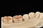 Natural Looking Composite Inlay Onlay Dental Restoration With Natural Appearance