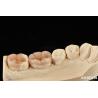 Buy cheap Natural Looking Composite Inlay Onlay Dental Restoration With Natural Appearance from wholesalers