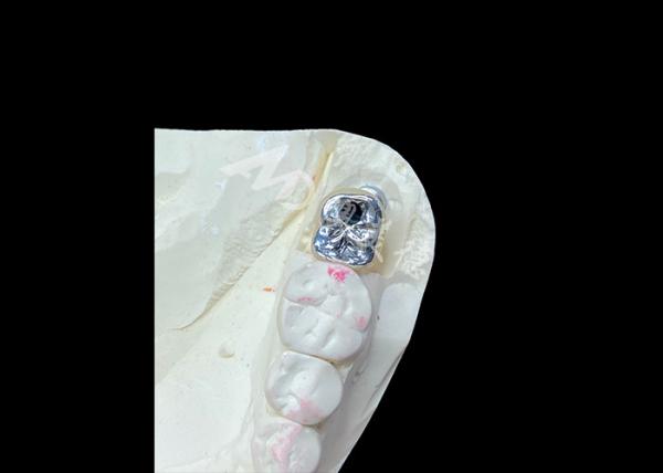 Dental Implant Crown With Titanium Abutment And Porcelain-Fused-to-Metal PFM
