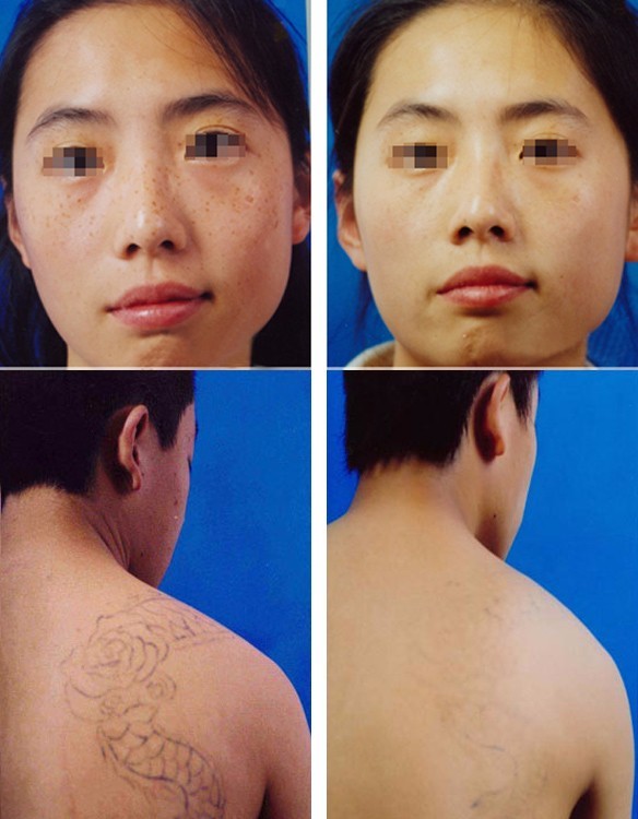 900ps Picosecond Laser Machine , 1 To 10Hz picocare Tattoo Removal Machine
