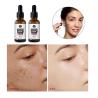 Buy cheap 1oz/30ml OEM Organic Tea Tree Relief Essence Face Serum Repair Acne Pimple Remover from wholesalers