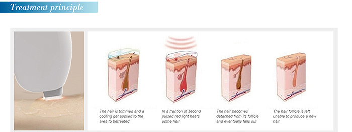 808nm diode laser hair removal machine treatment theory.jpg