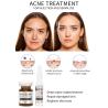 Buy cheap Stalidearm Acne Treatment Injection Serum Mesotherapy Nourishing No Side Effects from wholesalers
