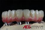 All On 6 Zirconia Dental Implant Supported Bridge Full Arch Custom
