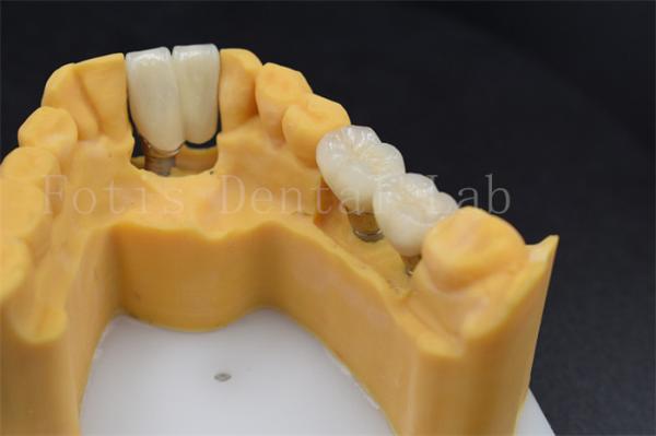Buy cheap Customizable Dental Restoration Implant Crown Replacement Various Sizes from wholesalers