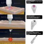 ABS Stainless Steel Plasma Facial Machine Pigment Removal Skin Brightening