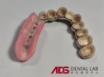 Dental Telescopic Crowns Prosthesis In Dentistry Customizable
