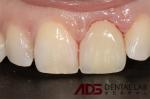 Natural Looking Aesthetic Ceramic Emax Veneer Dental Material Customized