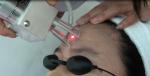 10600nm professional fractional CO2 laser machine for Acne Scars Treatment,