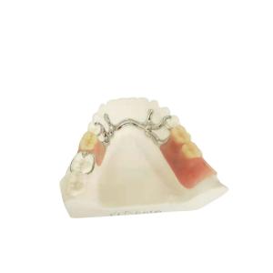 China Cocr Chrome Cast Removable Dental Crown Easy Clean Strong Hardness on sale