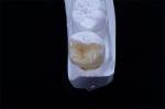 Dental Crown Composite Inlays And Onlays Restoration Customized Shape