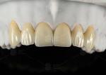 0.3mm-0.7mm Feldspathic EMAX Ceramic Veneers Natural Aesthetic Emax Dental