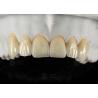 Buy cheap 0.3mm-0.7mm Feldspathic EMAX Ceramic Veneers Natural Aesthetic Emax Dental Veneers from wholesalers