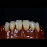 Tooth Multi Layered Zirconia Crown for Restorative Dentistry