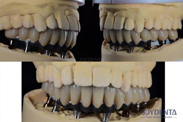 Buy cheap Titanium Multiple Teeth Dental Implant Prosthetic Surgery External Hexagon Connection from wholesalers