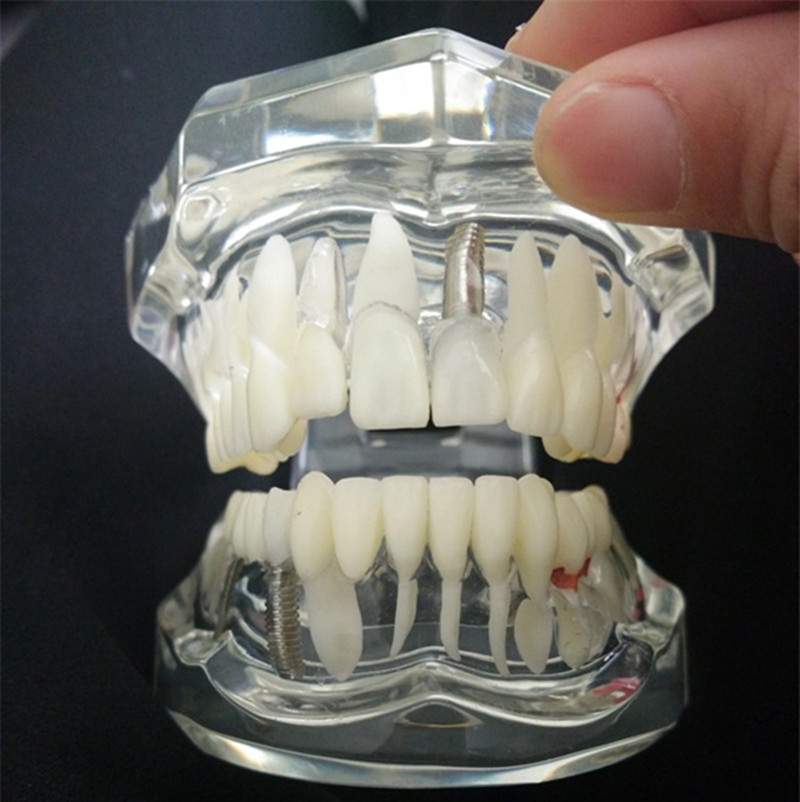 Removable Dental Materials Activity Pathological Teeth Model