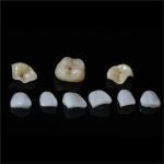 Tooth All Porcelain IPS Emax Inlay Onlay Veneer Aesthetic In Dentistry