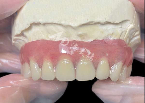 Buy cheap Titanium implant supported Bar Attachment Dentures from china dental lab from wholesalers