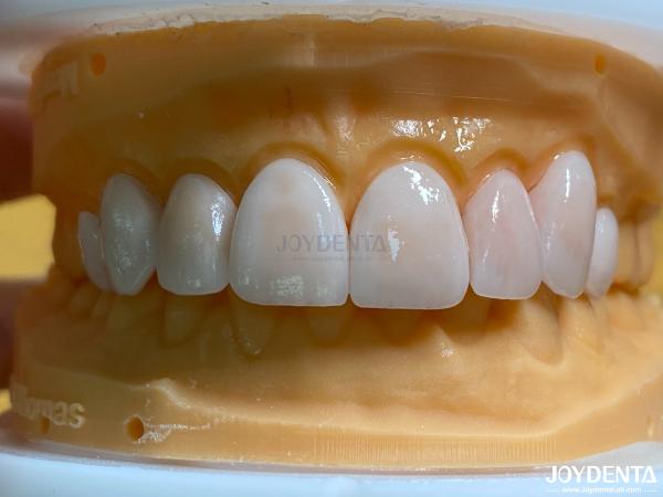 Buy cheap Lightweight and Smooth Dental Veneers Stain Resistance Long-lasting Durability for Optimal Comfort from wholesalers