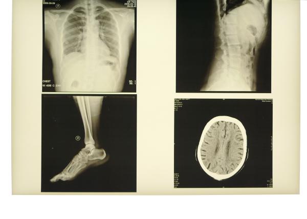Buy cheap 28cm * 35cm Medical Film Xray Paper For KND-DRYTEC-3000 Laser Printer from wholesalers