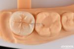 0.5mm-2mm Precise Fit Emax Dental Inlay Onlay For Reliable Tooth Restoration