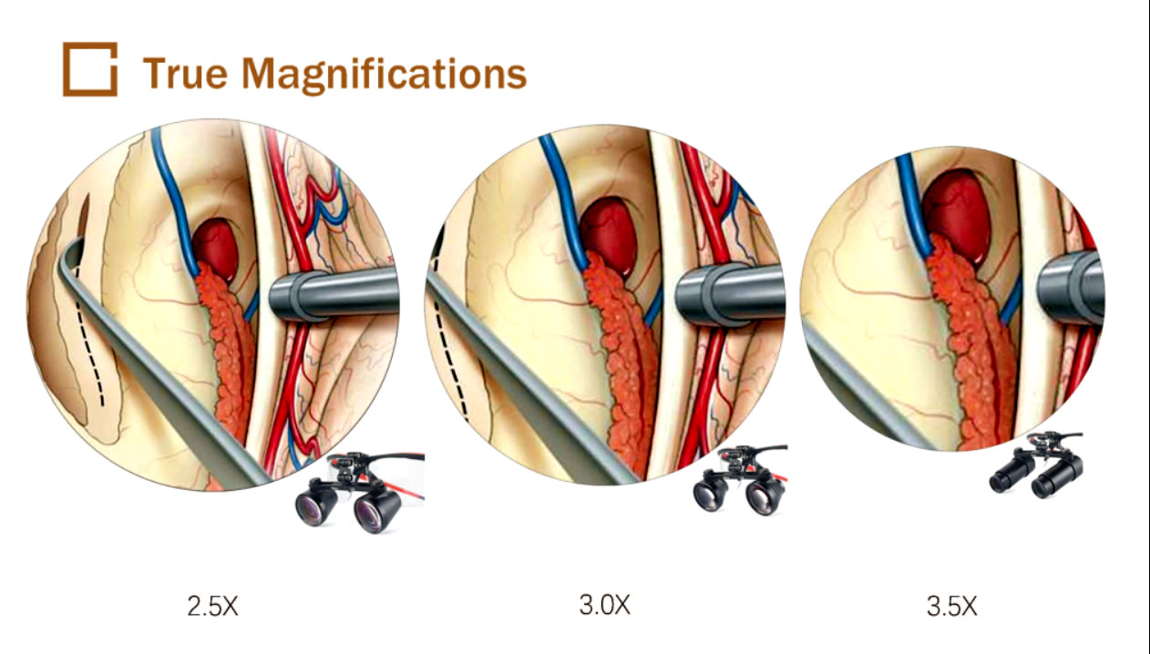 Anti Reflection Layer Binocular Loupes For Ophthalmology