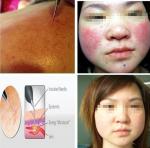 Newest High frequency professional cherry angiomas vascular removal for sale