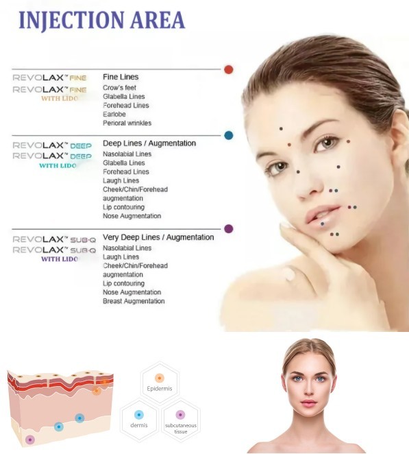 1.1ml Sodium Hyaluronic Acid Dermal Filler Body Injection