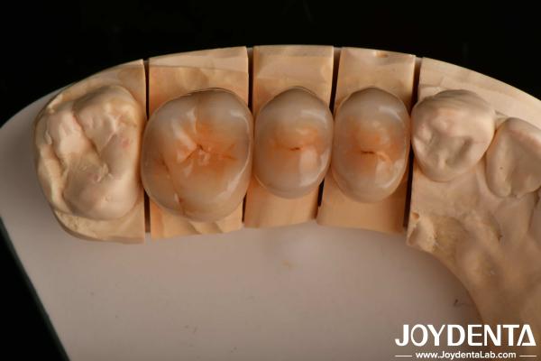 Buy cheap High Chipping Resistance And Natural-looking Esthetics With Multilayer Full Zirconia Technology from wholesalers