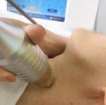 10.4 inch Touch Screen RF Microneedle Machine Thermal Cooling Scar Reduction