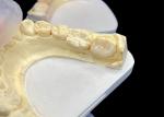IPS e.max Ceramic Inlays and Onlays for Molar Restoration Natural Aesthetic and