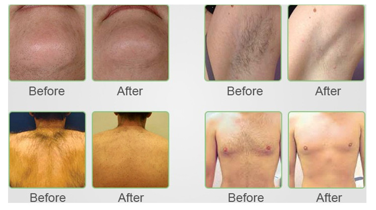 Diode Painless Laser Hair Removal Machine For Dark Skin T6.3A 1300 VA