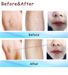 Ice Platinum Titanium Laser Removal Equipment 3 In 1 Hair Laser Machine 755nm