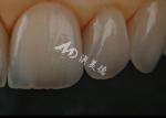 Buy cheap Chipping Resistance Zirconia Dental Crown For Anterior Teeth / Posterior Teeth from wholesalers