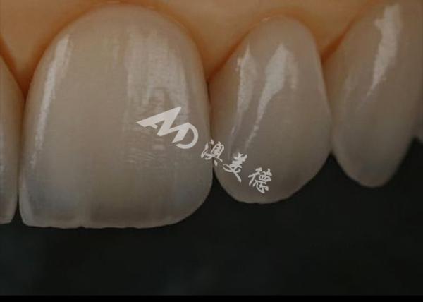 Buy cheap Chipping Resistance Zirconia Dental Crown For Anterior Teeth / Posterior Teeth from wholesalers