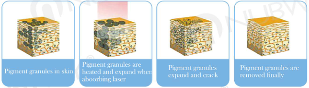ND YAG LASER.png