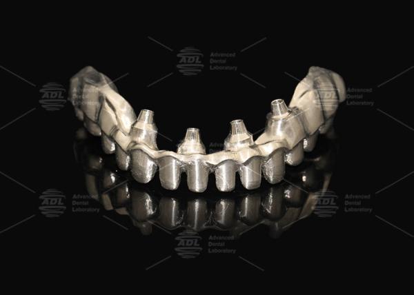 Hybrid Pink Porcelain Implant Crown Malong Full Arch Implant Bridge Immediate