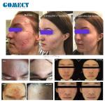 2025 Gomecy Hottest Cold Plasma Machine Beauty Plasma Lifting Machine