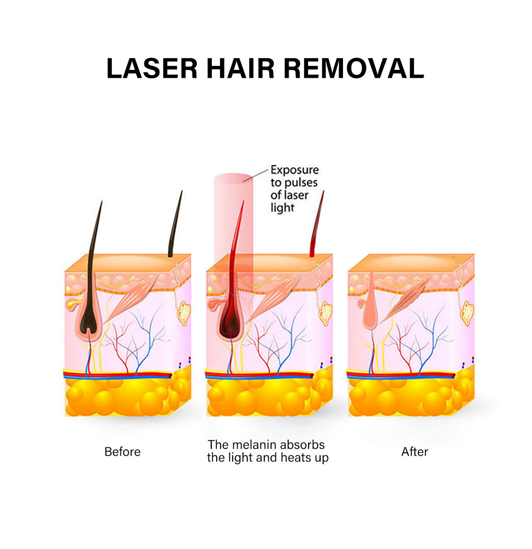 Portable Fiber Diode Laser Hair Removal Ice Machine For Skin Care And Beauty