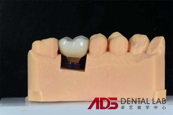 Buy cheap Dental Missing Teeth Cement Retained Implant Crown Replacement Custom from wholesalers