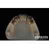 Buy cheap Steel Locator Dental Attachments , Precision Partial Denture Attachments Removable from wholesalers
