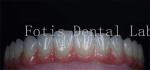 Buy cheap Smooth Surface Cosmetic Tooth Coverings Natural Porcelain Veneers Customizable from wholesalers