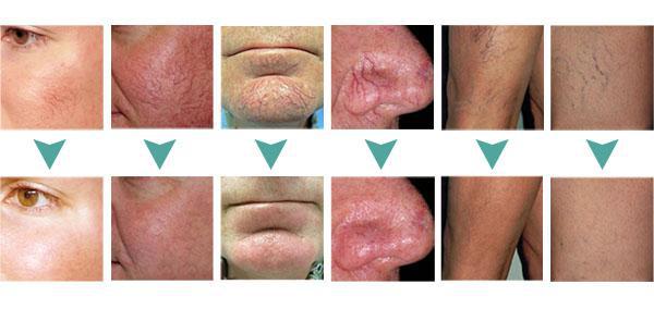 Spider vein removal picture 