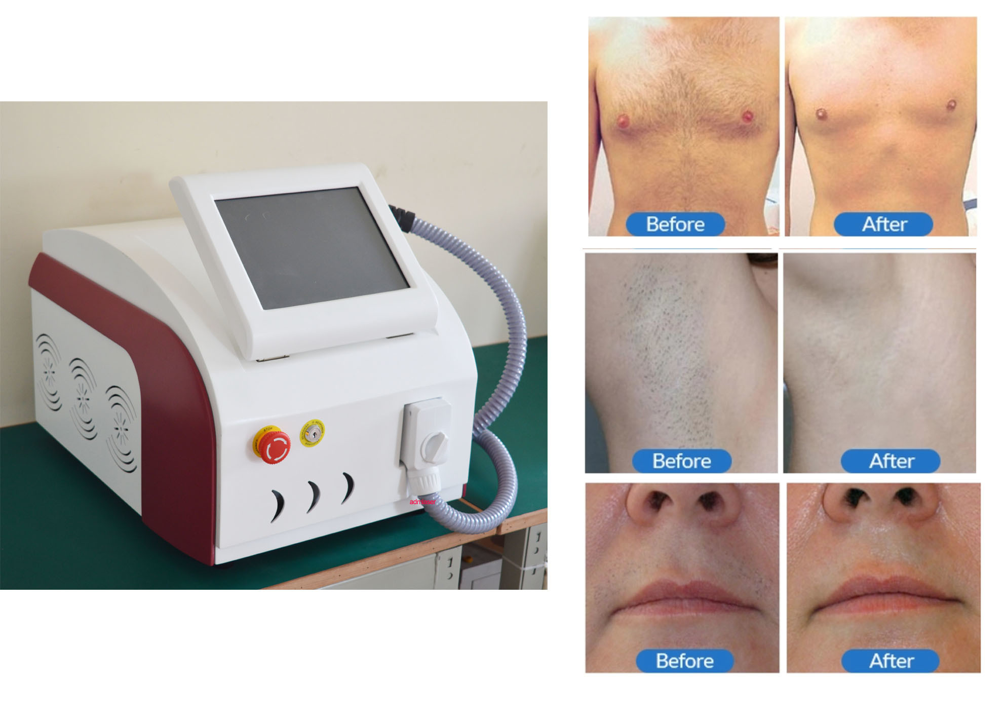 Diode Laser Hair Removal Equipment With Medical Eye Goggles And Glasses