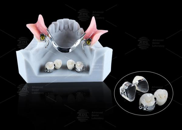 Buy cheap CE FDA Ball Attachment Dentures Comfortable Denture Ball Attachment Long Lasting from wholesalers