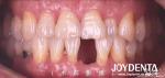 Customizable Dental Maryland Resin Bonded Bridges for Anterior And Premolar